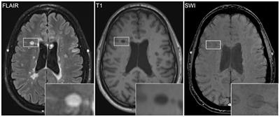 Peripheral Hemolysis in Relation to Iron Rim Presence and Brain Volume in Multiple Sclerosis